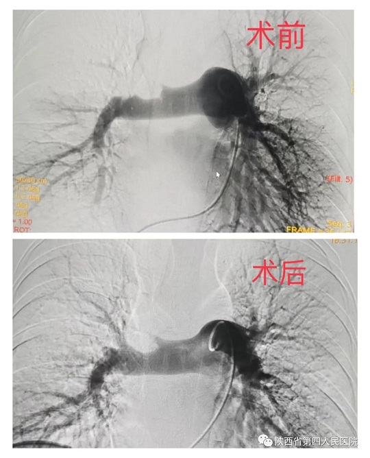 陕西省第四人民21点基本策略
心血管内科成功救治危重肺栓塞患者