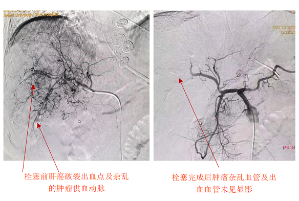 肝癌破裂大出血命悬一线——21点策略指南站
急诊介入止血化险为夷